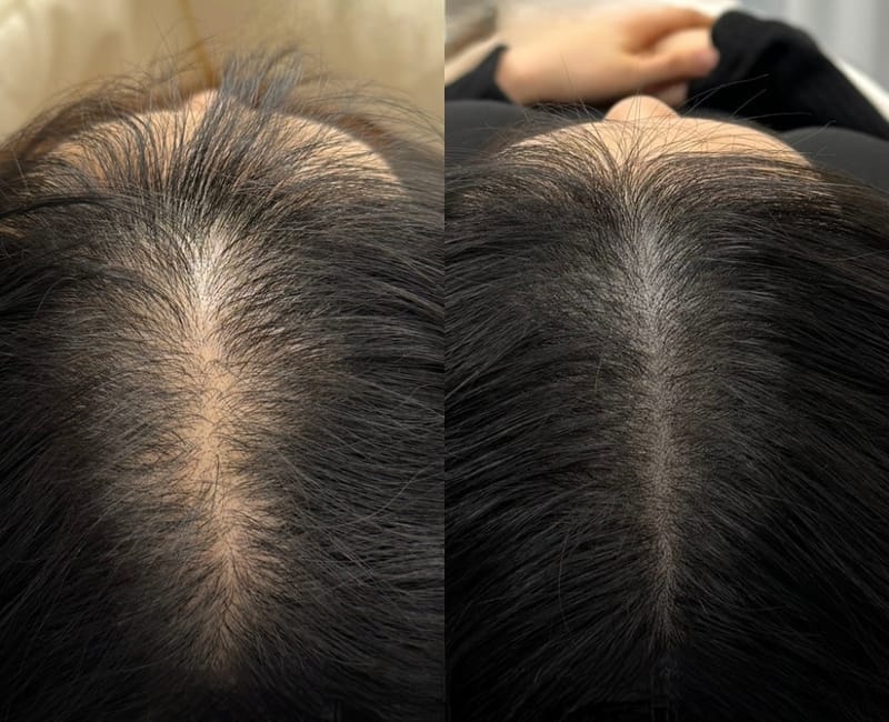[경북 경산시] 뷰티블룸 경산점 두피SMP(탈모커버) 체험단