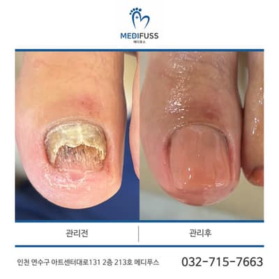 [인천 연수구] 메디푸스